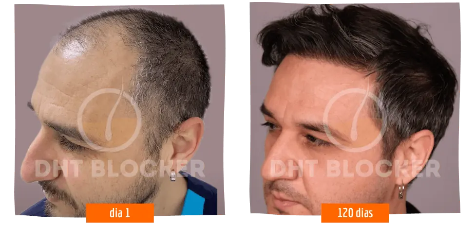 Resultado antes e depois do tratamento DHT Blocker — crescimento capilar visível