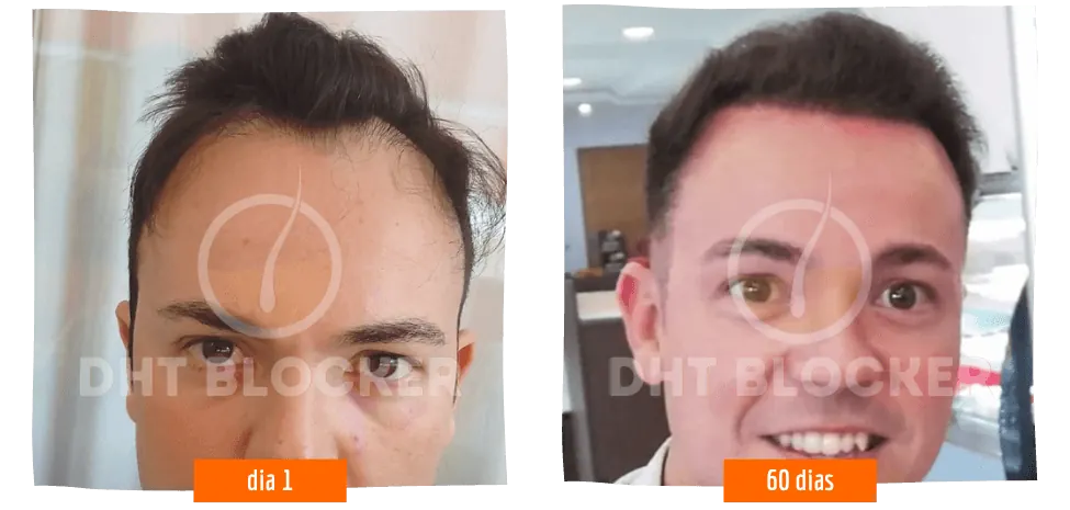 Resultado antes e depois tratamento DHT Blocker — recuperação capilar real