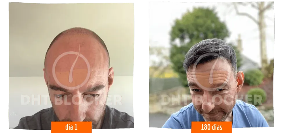Antes e depois DHT Blocker — calvície revertida com tratamento capilar